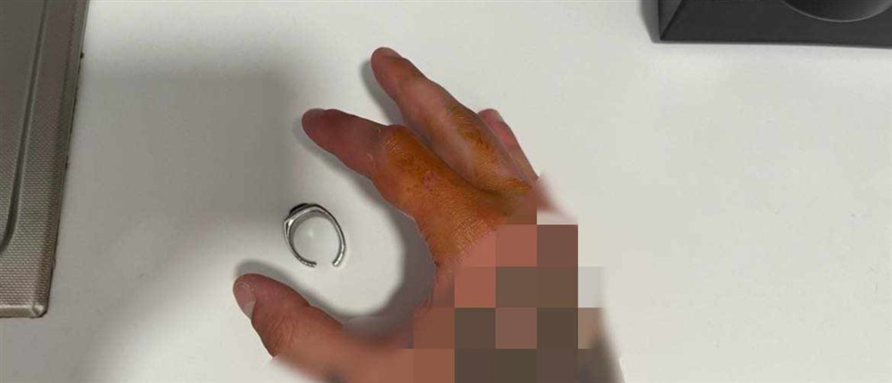 Δαχτυλίδι - Χαλκιδική