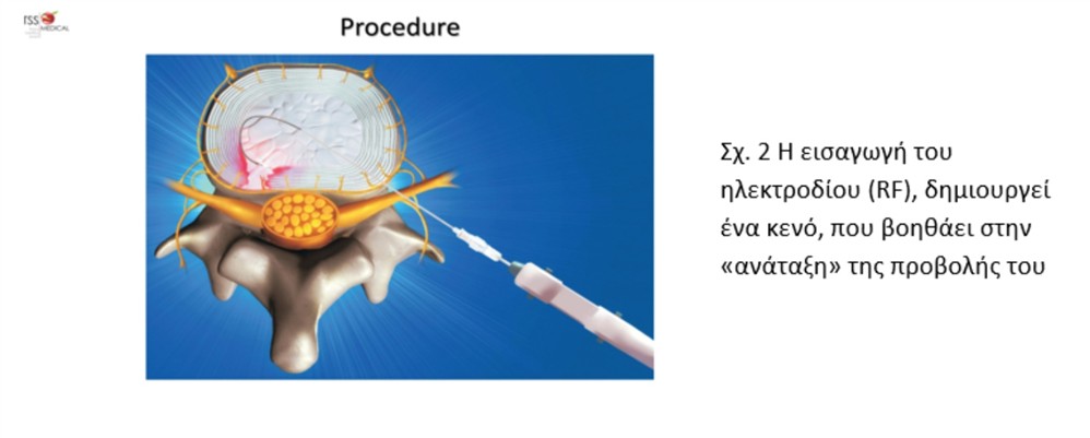 HHG - ΔΡΥΜΟΥΣΗΣ ΜΕΛΕΤΙΟΣ HHG - ΔΡΥΜΟΥΣΗΣ ΜΕΛΕΤΙΟΣ