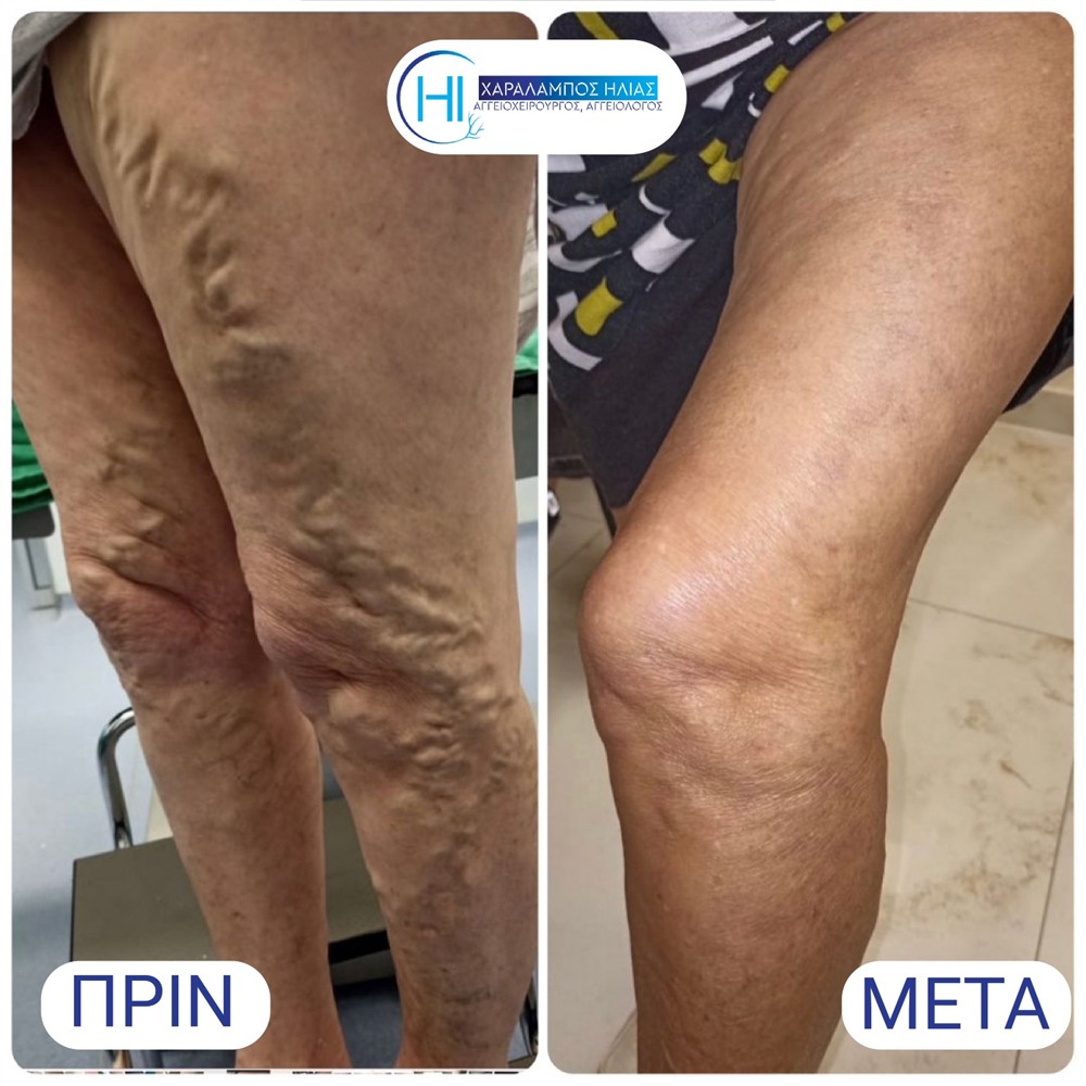 Χαράλαμπος Ηλίας - κιρσοί