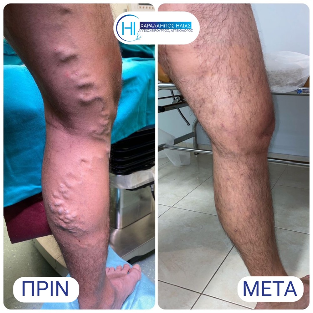 Χαράλαμπος Ηλίας - κιρσοί