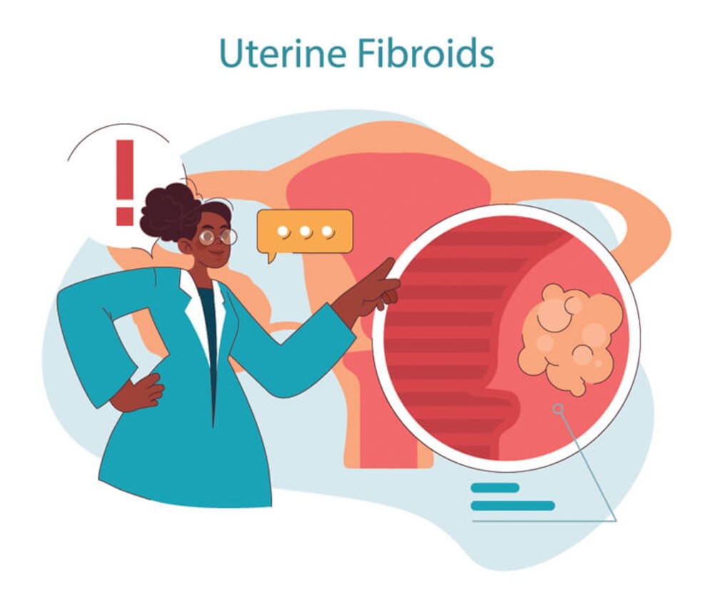 HHG - Ινομύωμα