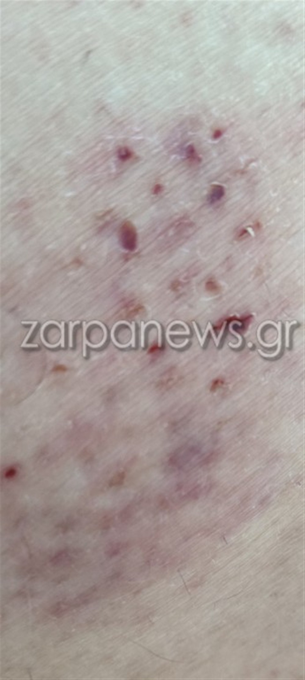 δάγκωμα χελώνας Χανιά δάγκωμα χελώνας Χανιά