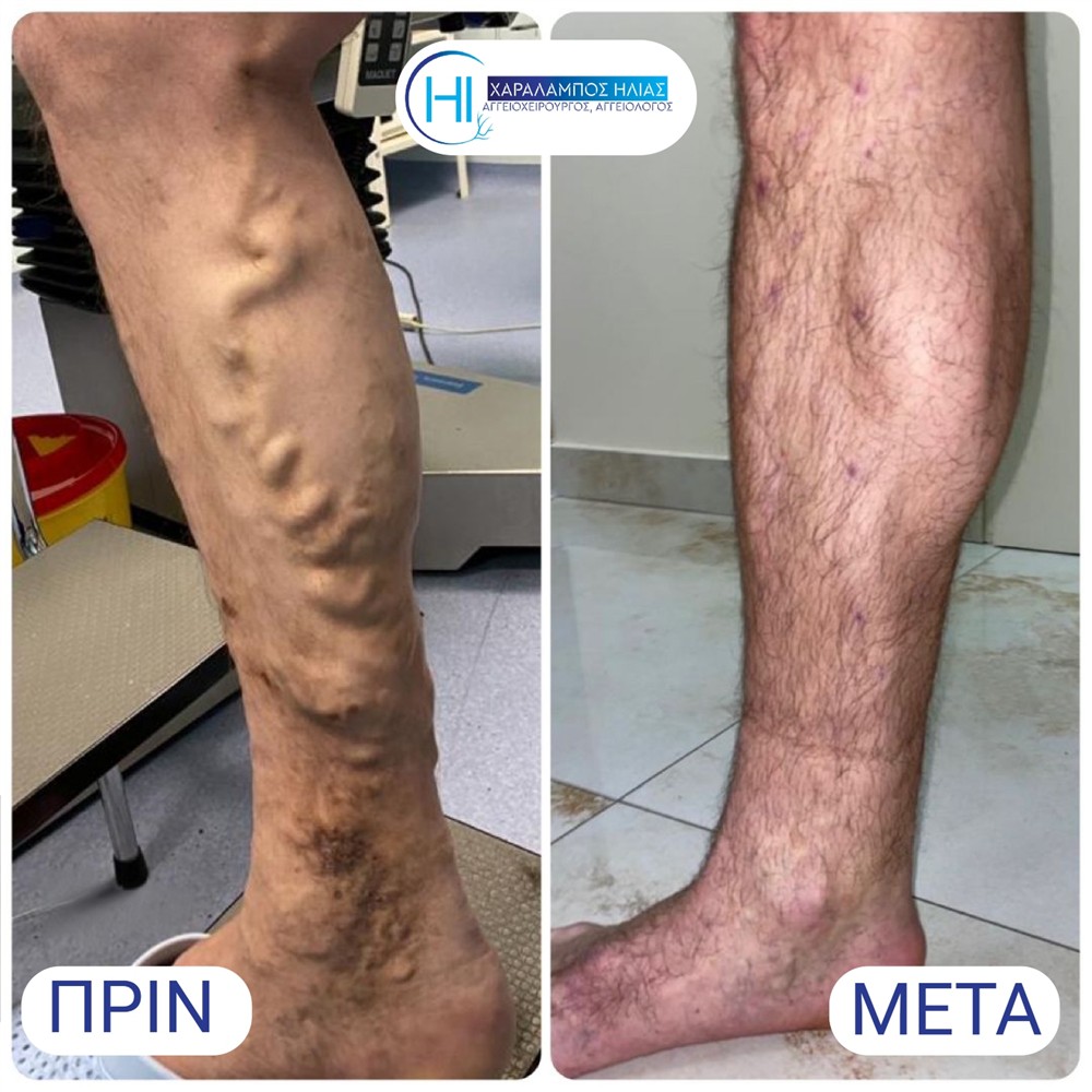 Χαράλαμπος Ηλίας - κιρσοί