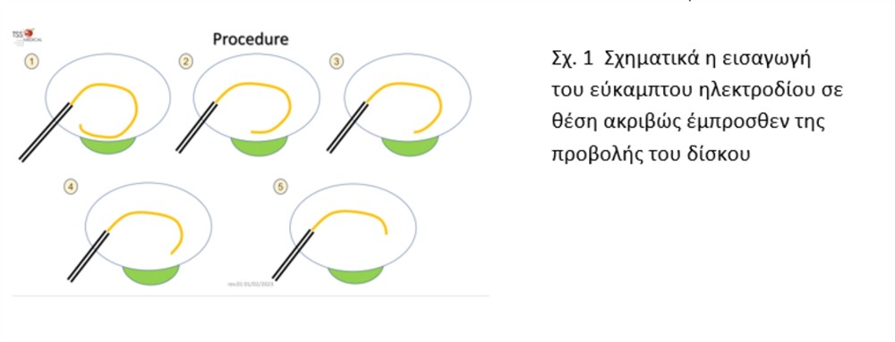 HHG - ΔΡΥΜΟΥΣΗΣ ΜΕΛΕΤΙΟΣ HHG - ΔΡΥΜΟΥΣΗΣ ΜΕΛΕΤΙΟΣ